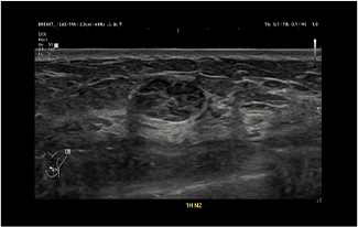 Healthy Breast siêu âm ung thư vú img9 m