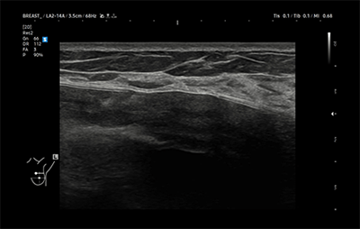 healthy breast siêu âm túi độn img10