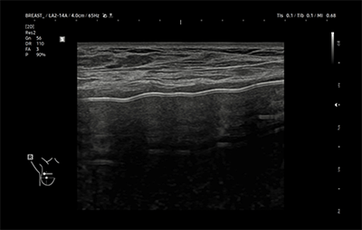healthy breast siêu âm túi độn img11