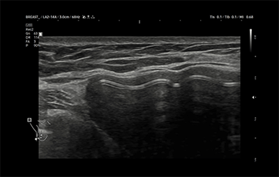 healthy breast siêu âm túi độn img6