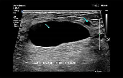 healthy breast siêu âm ung thư vú img10