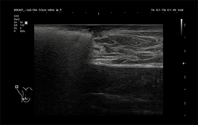 healthy breast siêu âm ung thư vú img12