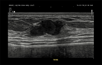 healthy breast siêu âm ung thư vú img8
