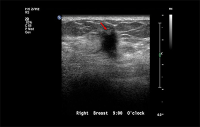 healthy breast siêu âm ung thư vú img9